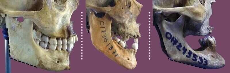 Human Skull Aging