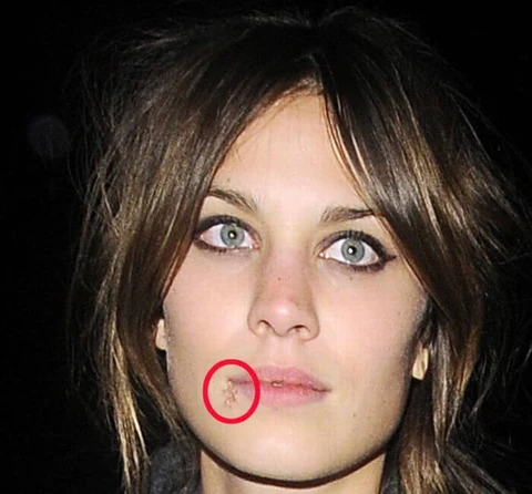 Alexa Chung with cold sore on right