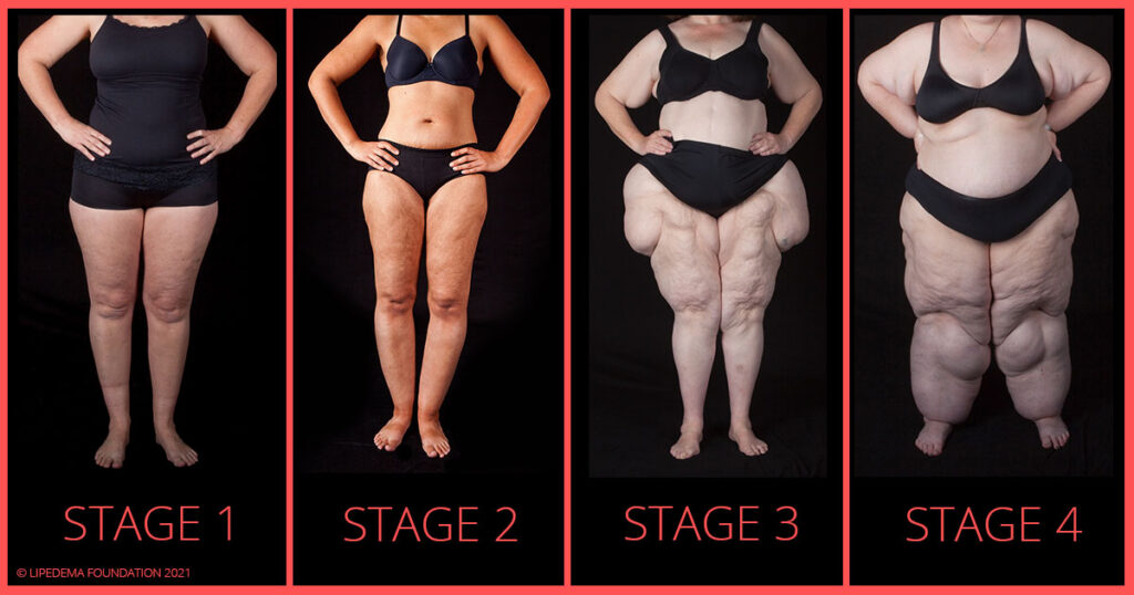 Lipedema 4 Stages